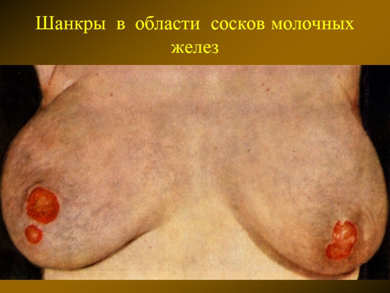 Шанкры  в  области  сосков молочных  желез